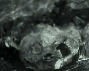 The horror skull and bones of a young Jewish girl, still wearing a ribbon in her hair, was found at an abandoned Nazi death camp in 1945.